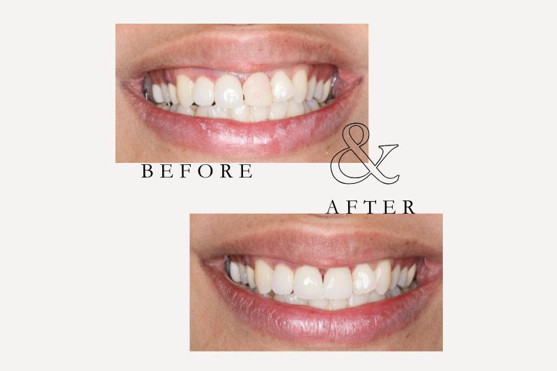 Before and after porcelain veneers improving stained and worn teeth at Castle Hill Dental Care