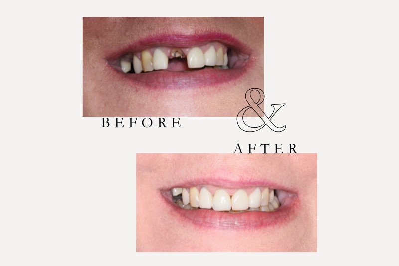 Before & After Smiles | Dentist Castle Hill Before and after porcelain crown restoring broken tooth at Castle Hill Dental Care