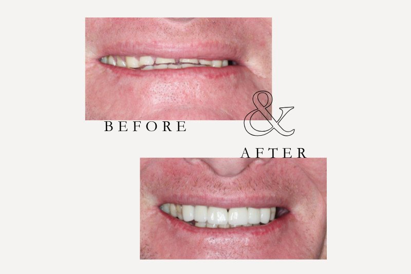 Before and after porcelain veneers improving heavily worn teeth at Castle Hil Dental Care