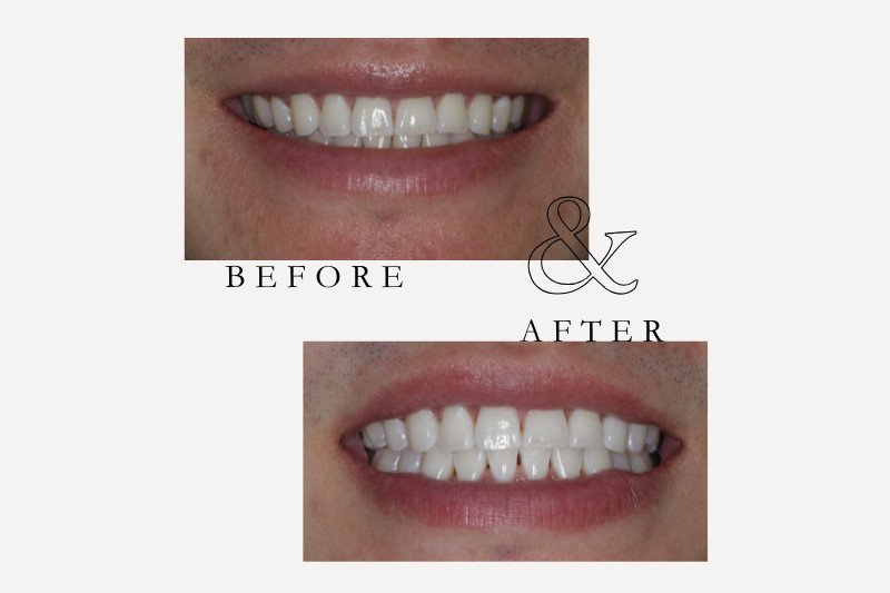 Before & After Smiles | Dentist Castle Hill Teeth Whitening Before and After (800 x 533 px)