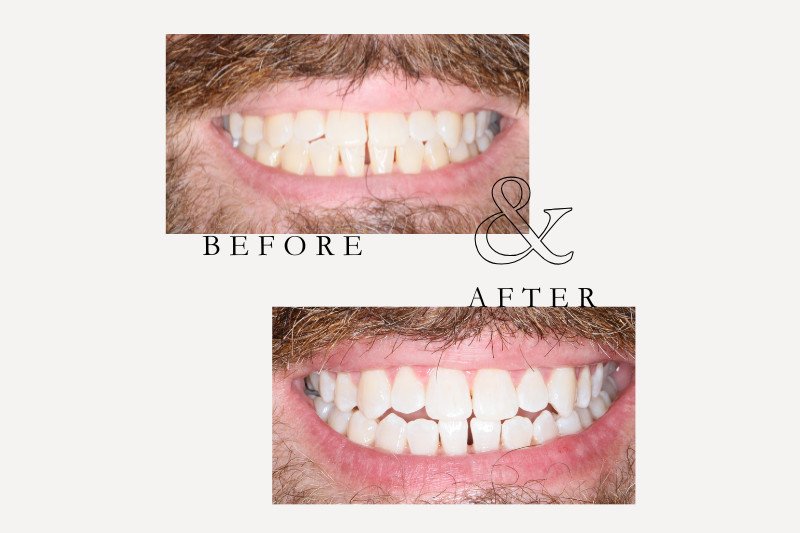 Before & After Smiles | Dentist Castle Hill whitening before & after - 1