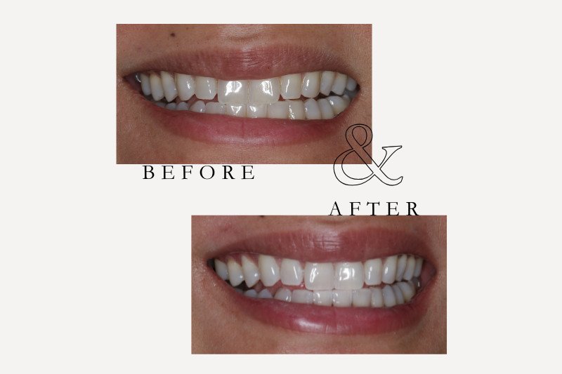 Before & After Smiles | Dentist Castle Hill whitening before & after - 2
