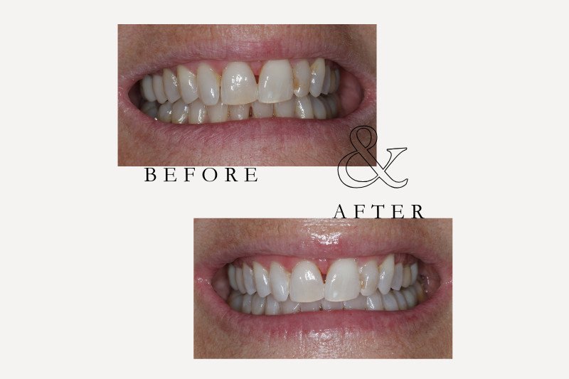 Before & After Smiles | Dentist Castle Hill whitening before & after - 3