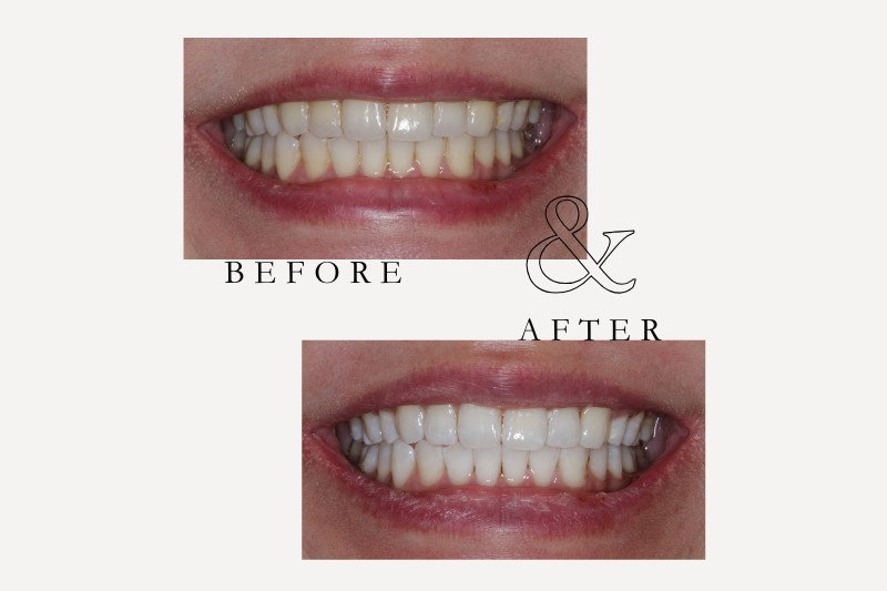 Before & After Smiles | Dentist Castle Hill whitening before & after - 4